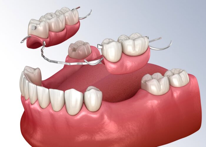 Galeria-Dental-House-03_0004_Protesis Parcial Removible-min