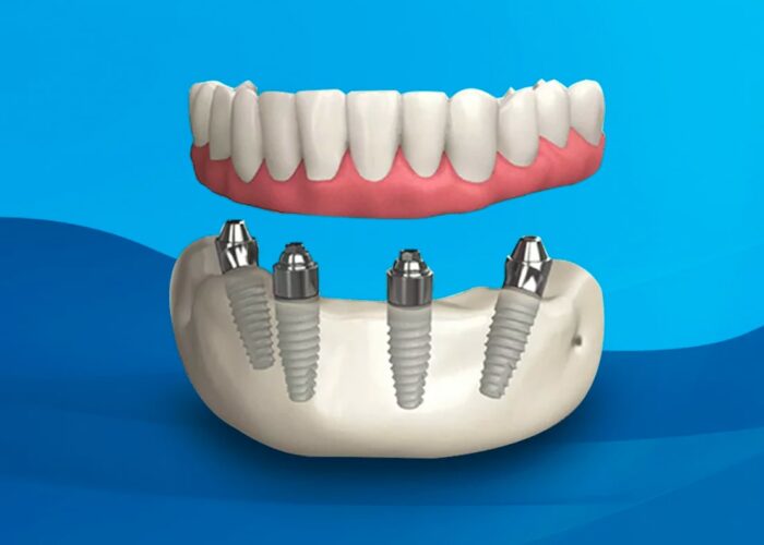 Galeria-Dental-House-03_0005_protesis fija-min