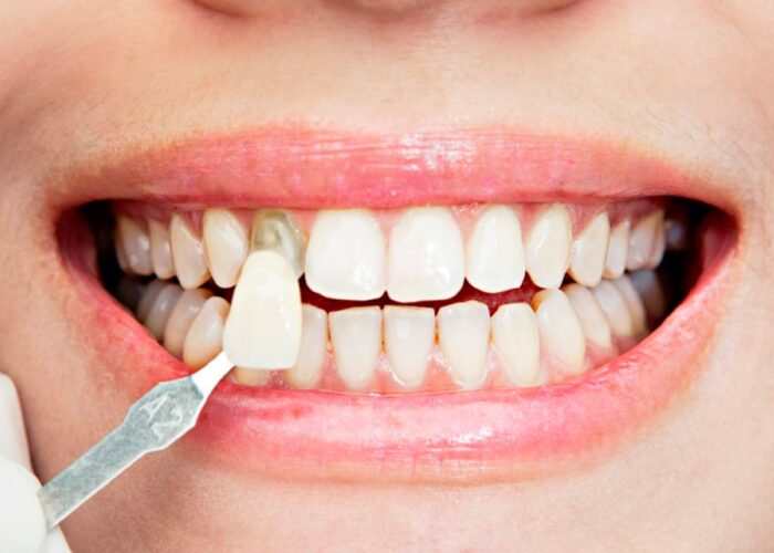 Galeria-Dental-House-03_0006_Carillas Dentales-min Galeria-Dental-House-03_0006_Carillas Dentales-min